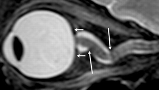 Too much pressure: A build-up of cerebrospinal fluid is cited as the cause of nearsightedness in long-duration astronauts. (Image: Alperin et al.)
